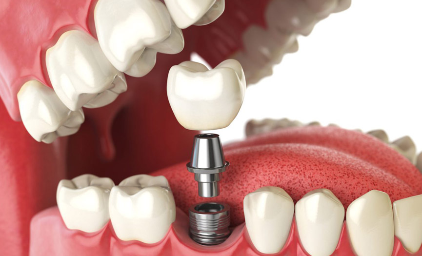 Dental Implants by Smile Experts in St. Albert