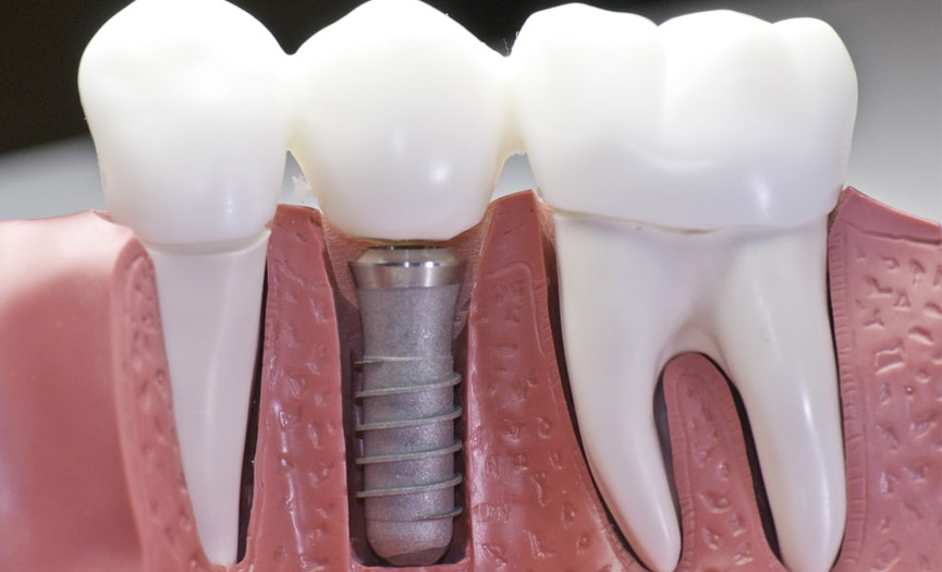 Implant Retained Dentures by Smile Experts in St. Albert