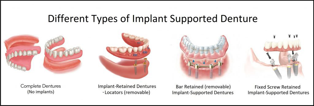 Implant Retained (Removable) Denture Implants