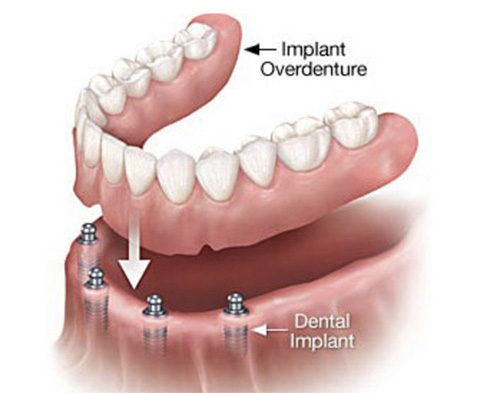 Implant Supported Dentures - Impant Overdenture