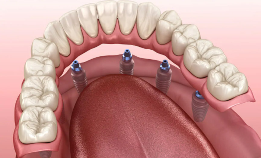 Implant Supported Dentures by Smile Experts in St. Albert